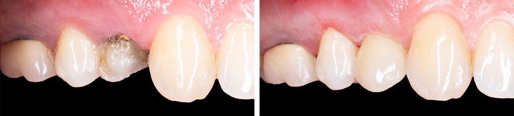 Before and After Crown Photo
