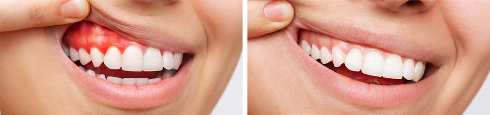Before and After Gum Treatment Photo