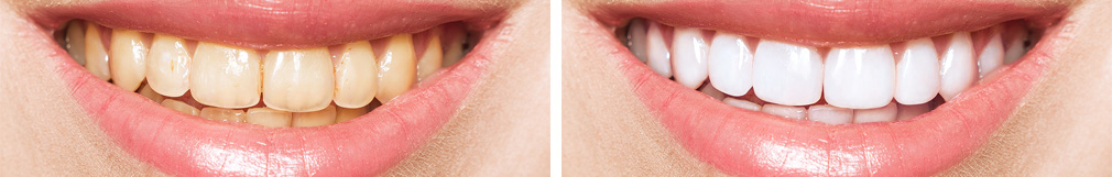 Before and After Teeth Whitening Photo